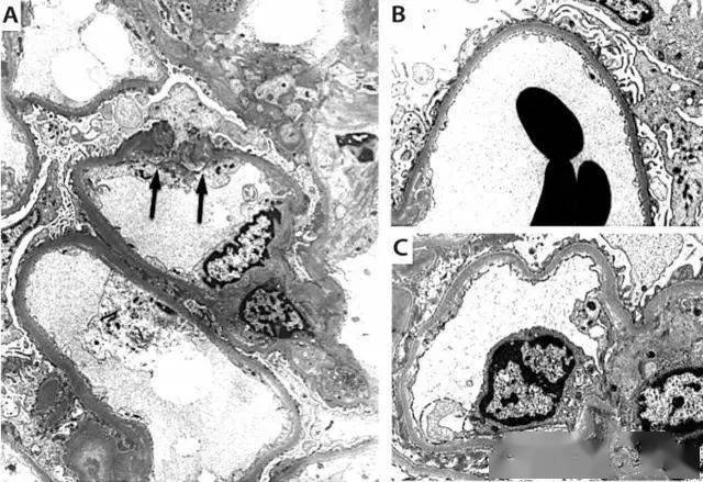 综合征|不一样的肺出血肾炎综合征