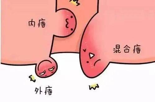 同样得了痔疮,为何有的人不痛不出血?