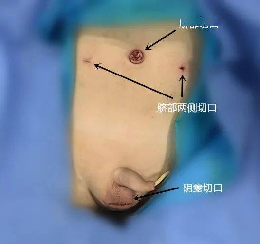 这是一例双侧高位隐睾,腹腔镜手术刚结束时所拍摄