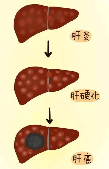 【话肿瘤】肝炎,肝硬化离肝癌有多远?如何防治肝癌