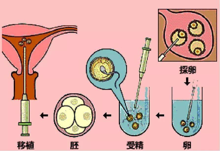 怎样选择助孕方式?