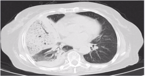 识别|肺部 CT 秒杀:快速识别各类影像