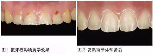 两滴仿生修补液让缺损牙齿表面“长”出与天然牙釉质