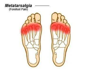 「运动康复」前足底痛( 跖痛metatarsalgia )_症状