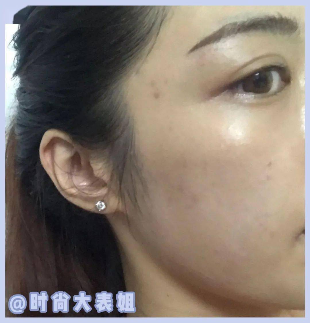 护肤|经常挤痘痘的女生，都是这个下场！（真人实测）