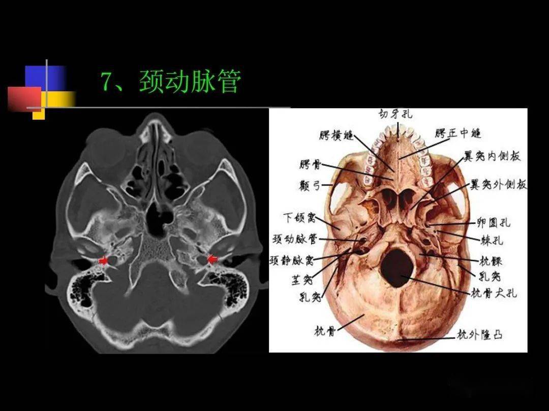 鼻咽部ct解剖