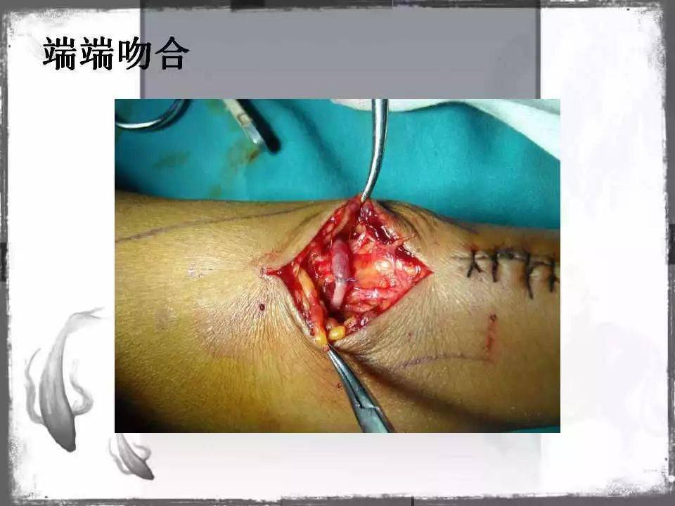 自体|血管通路 | 自体动静脉内瘘成形术