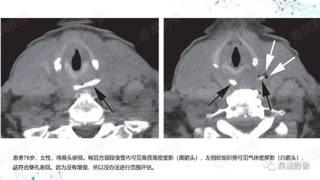 颈长肌钙化性肌腱炎扁桃体炎影像表现会厌炎影像表现右侧恶性外耳道