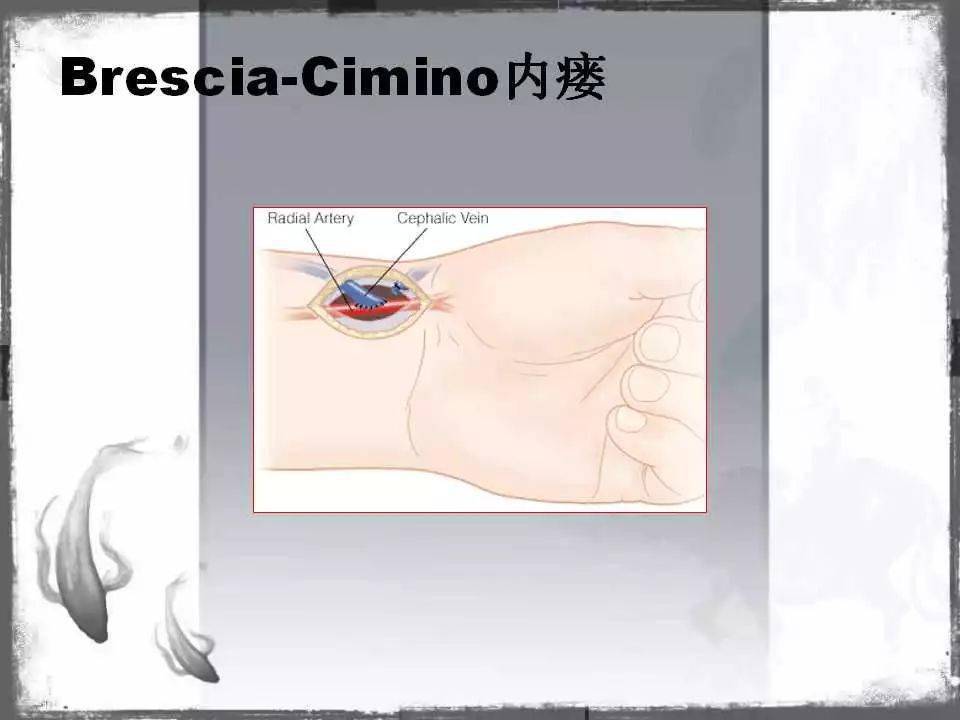 自体|血管通路 | 自体动静脉内瘘成形术