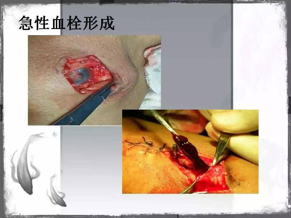 自体|血管通路 | 自体动静脉内瘘成形术