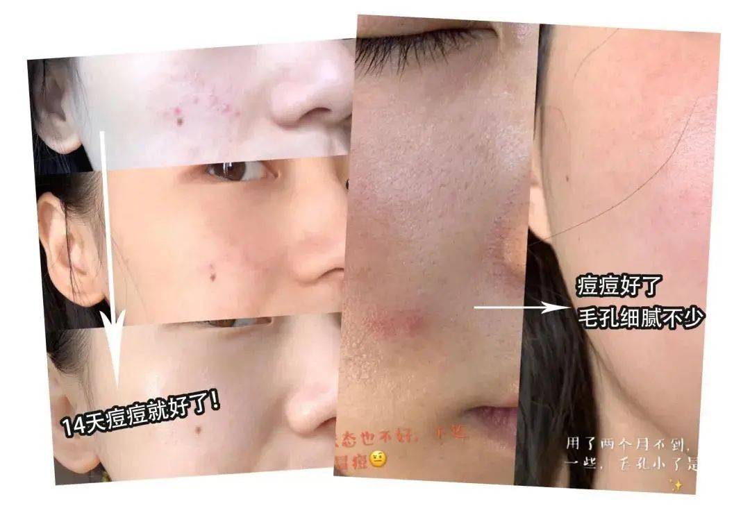 贫民窟|杨幂熬夜后护肤要花2万块？怪不得皮肤吹弹可破！贫民窟女孩就不配消除熬夜痘、黑眼圈吗？