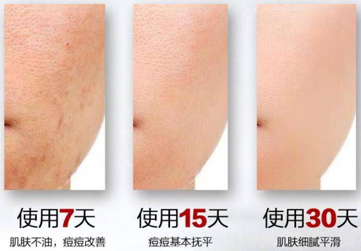 痘痘|夏天变黑长痘不可怕，赶紧用它，让你的皮肤恢复婴儿的光滑，痘痘，黑头，螨虫全都消失了