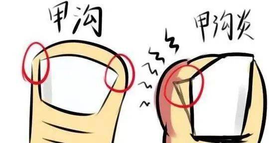 甲沟炎是什么感染 b1804c959b45412b90ceb18198f08696.jpeg