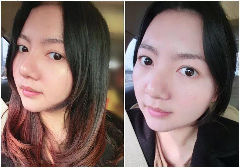 痘痘|夏天变黑长痘不可怕，赶紧用它，让你的皮肤恢复婴儿的光滑，痘痘，黑头，螨虫全都消失了