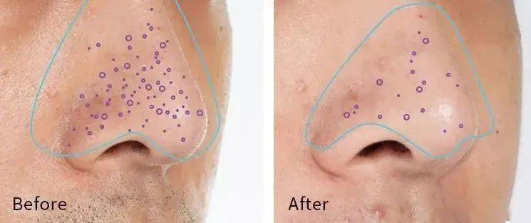 潘达|日本20年老木头,经1300°高温烧成“变态黑炭”,几分钟溶掉黑头,太神奇!