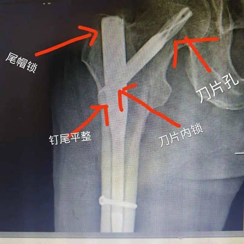 【医疗动态】我院骨一科为患者成功实施右股骨粗隆间骨折闭合复位apfn