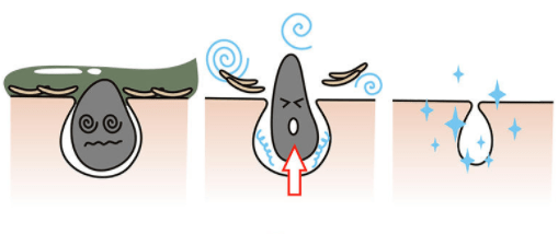 张天|长期闭口、粉刺、痘痘满脸的人，微镜头下毛孔竟然是这样的！赶紧get林允、张天爱的0毛孔秘籍吧！