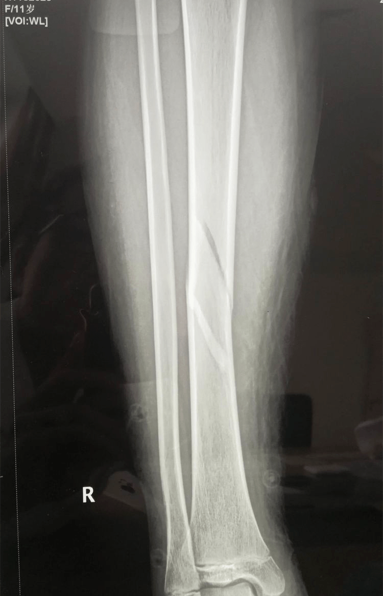 技术创伤骨一科完成两例弹性髓内针治疗小儿长骨骨折手术