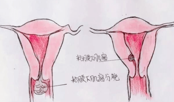 什么情况会引起子宫肌瘤 60a34c462e6b4e8a8ef7c246f6eb1eb6.png