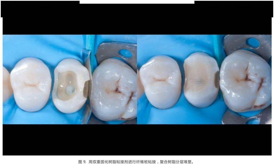 病例分享前磨牙根管治疗后的高嵌体修复