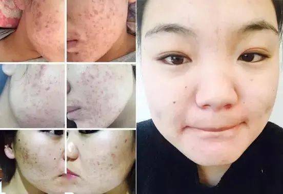 张天|长期闭口、粉刺、痘痘满脸的人，微镜头下毛孔竟然是这样的！赶紧get林允、张天爱的0毛孔秘籍吧！