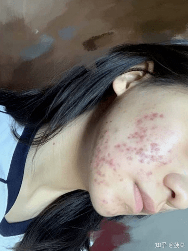 张天|长期闭口、粉刺、痘痘满脸的人，微镜头下毛孔竟然是这样的！赶紧get林允、张天爱的0毛孔秘籍吧！