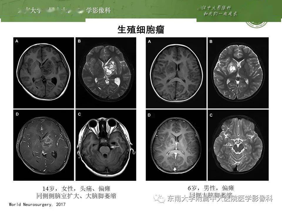 【晨读结果公布】2020.09.21 神经系统疾病——生殖细胞肿瘤