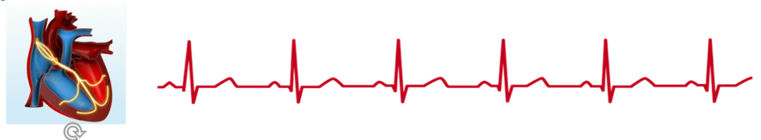 疫情|【卫生社团】新冠疫情期间，房颤患者如何做好自我管理？