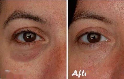 黑眼圈|马应龙新款眼霜买1送5，拼网速抢购中！早晚用一次，轻松缓解黑眼圈、浮肿眼袋、细纹皱纹，40岁阿姨也能抹出少女眼！