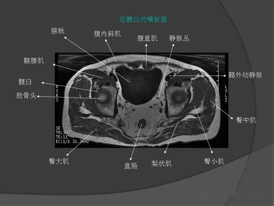 骨盆肌肉mri断层解剖