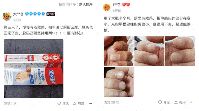 真菌|用“笔”刷一刷，灰指甲竟慢慢变光亮了