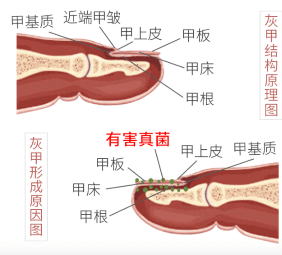 真菌|用“笔”刷一刷，灰指甲竟慢慢变光亮了
