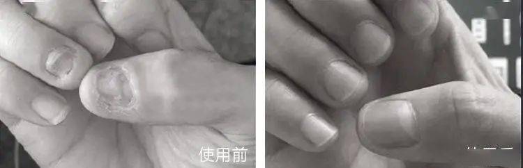 真菌|用“笔”刷一刷，灰指甲竟慢慢变光亮了