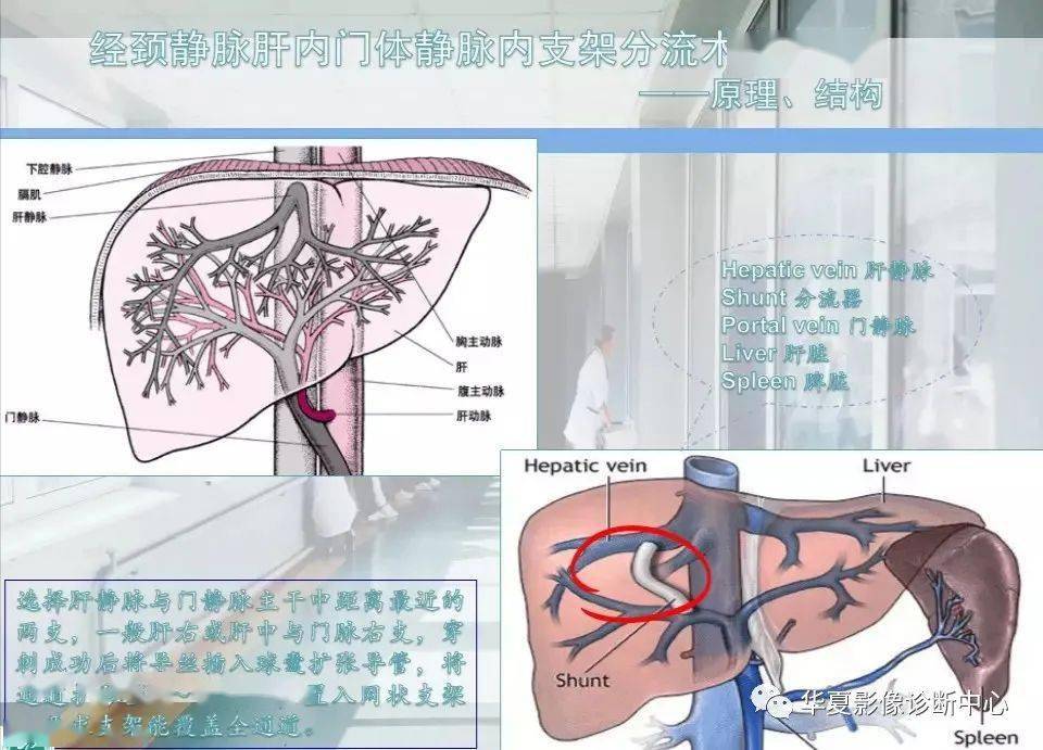 【观图学识】经颈静脉肝内门体分流术简易流程;介入剂量章使用