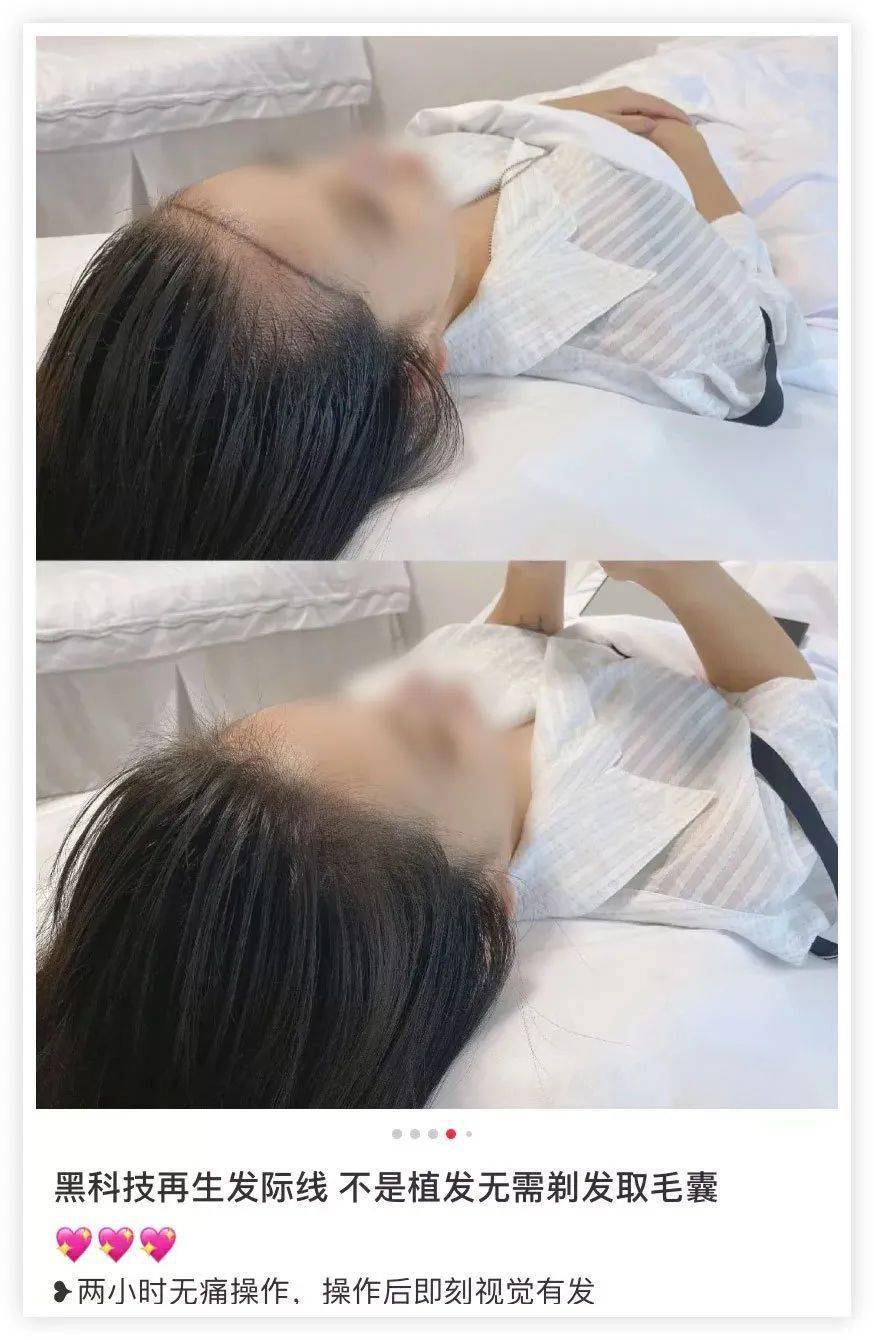 移植|国庆回去，我打算植发了！