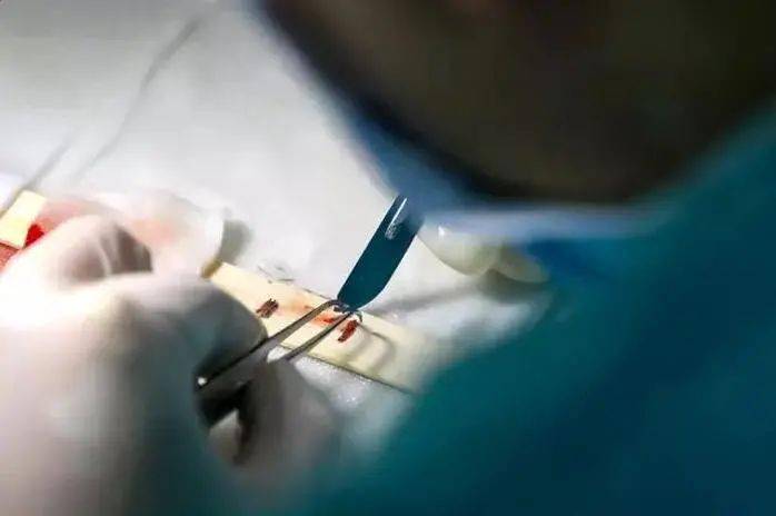 移植|国庆回去，我打算植发了！