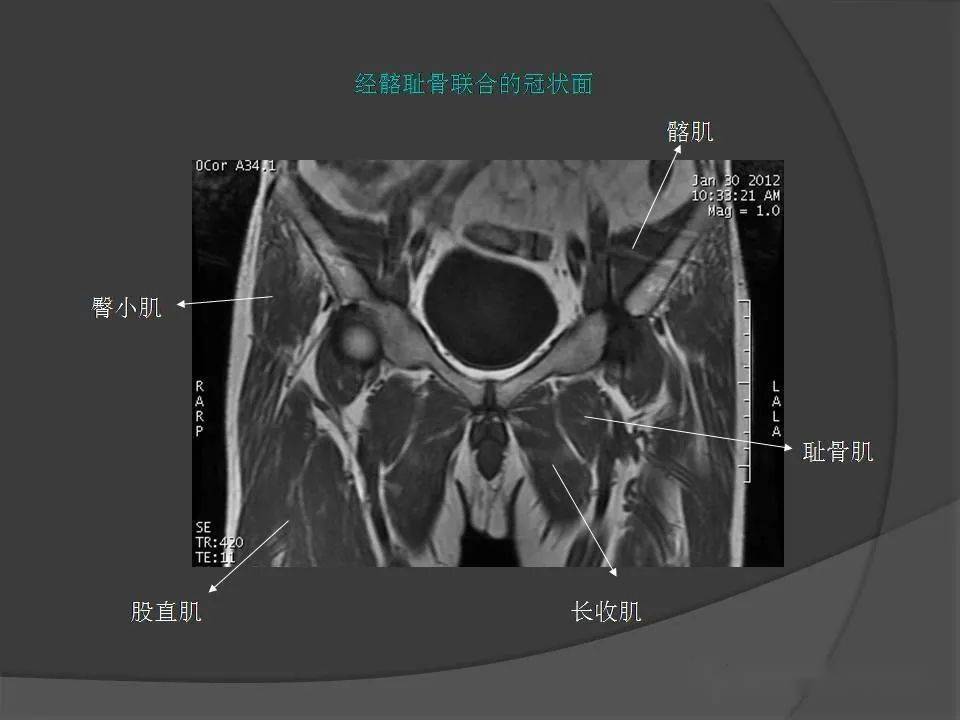 骨盆肌肉mri断层解剖