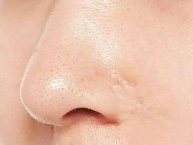 黑头|你还要被骗多久！黑头作战大解析，是真有用还是智商税？