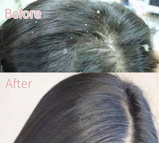 头发|头皮发痒，出油，还掉发？原来是你的洗发水没选好...