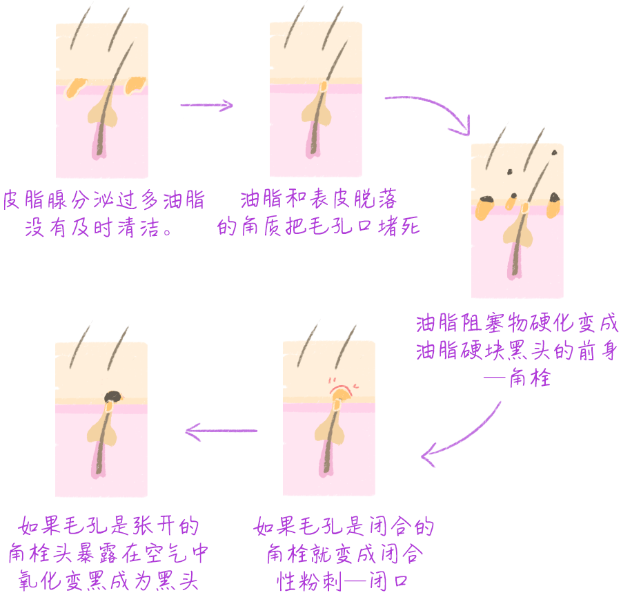 黑头|你还要被骗多久！黑头作战大解析，是真有用还是智商税？