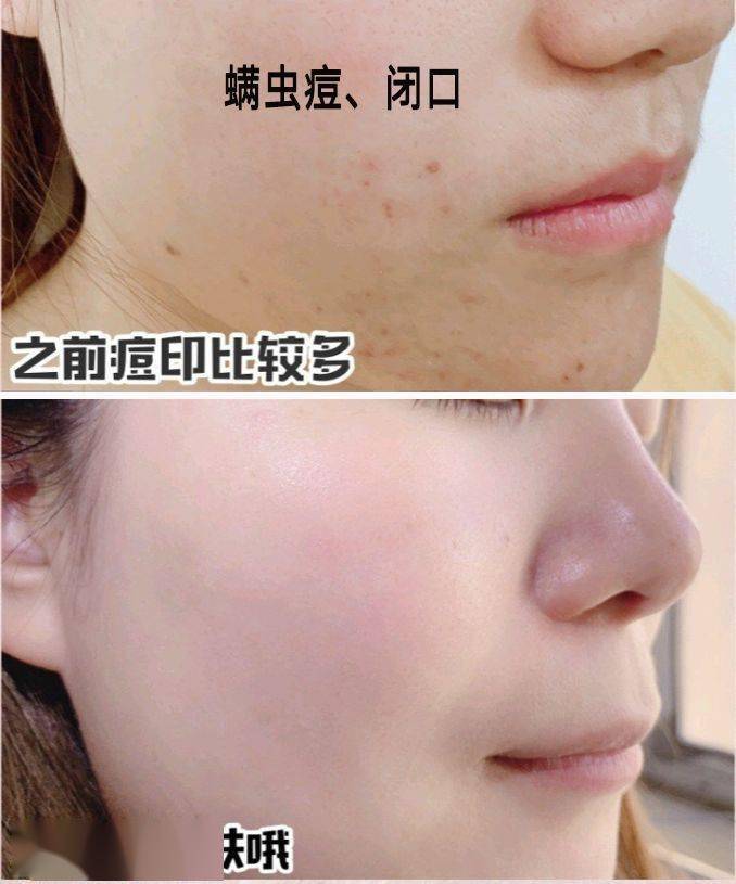 氨基酸|拒绝“螨虫脸”，5秒揉一揉，螨虫全出来了，痘痘黑头全没了！