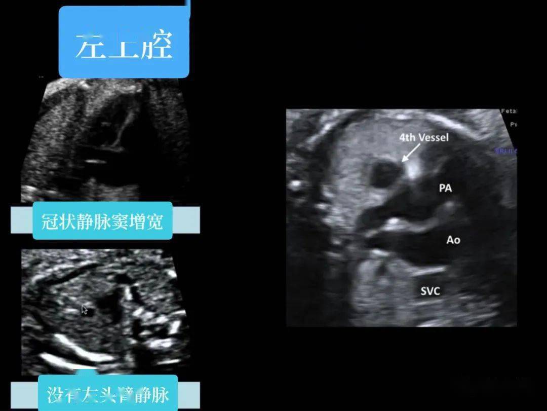 异常篇:三血管气管切面——胎儿心超最重要的切面