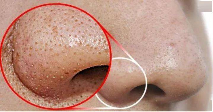 氨基酸|拒绝“螨虫脸”，5秒揉一揉，螨虫全出来了，痘痘黑头全没了！