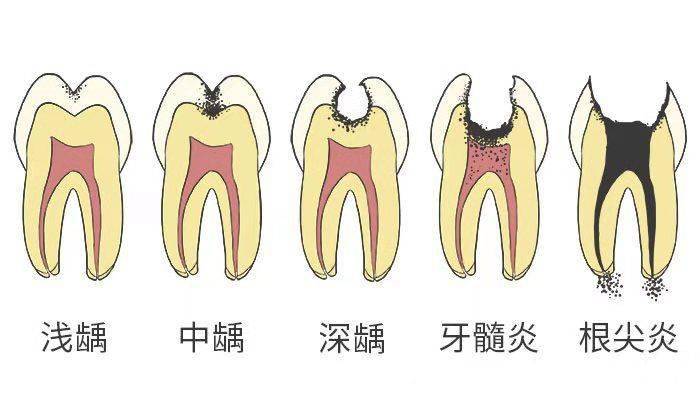 孩子|最伤孩子牙齿的不是糖，而是……4岁男孩牙齿几乎全黑