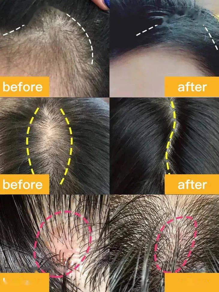 国货|还是老国货好使，头发长出来了，看着真年轻