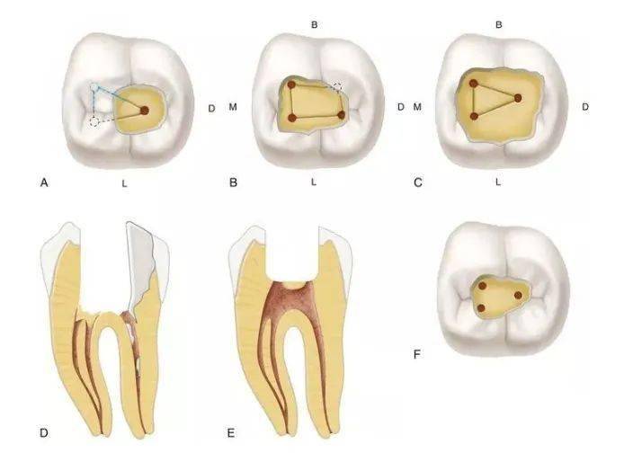 临床上,多根管牙若因某些原因,寻找根管口有困难时,除了应用牙齿髓腔