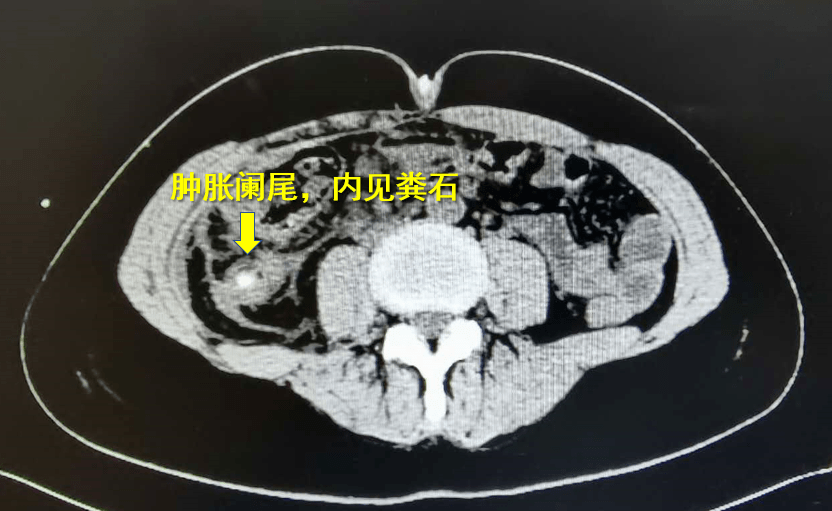 血小板|生死时刻，力挽生命 |广东省中医院多学科协作成功救治一例重度血小板减少并感染性休克患者