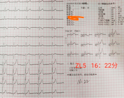 心电图呈「墓碑样」改变就是心肌梗死?错!