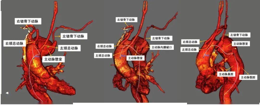 复合手术遇见罕见病例_主动脉