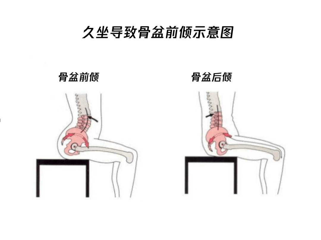 前紧后松,引起了我们称之为下交叉综合征